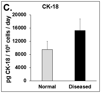 Expression of pro-inflammatory cytokines and fibrotic markers. Levels of (A) IL-6, a pro-inflammatory cytokine, and (B) MCP-1, a pro-inflammatory chemokine, in Normal (grey bar) and Diseased (black bar) PHHs in the hTCS on day 14. The fibrotic markers of (C) CK-18 and (D) TGF-β were measured in Normal (grey bar) and Diseased (black bar) PHHs on day 14. Error bars represent standard deviation (n ≥ 3 wells).