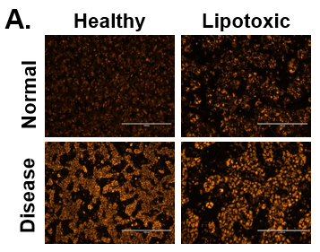 Increase in lipid synthesis when treated with lipotoxic media (25 mM glucose and 320 µM Oleic acid). Normal (top row) and Diseased (bottom row) PHHs treated with high glucose and Oleic acid in the hTCS. (B) Quantitation of Nile Red staining on day 14 in Normal (grey bars) and Diseased (black bars) PHHs. Error bars represent standard deviation (n ≥ 3 wells).