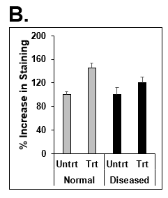 Increase in lipid synthesis when treated with lipotoxic media (25 mM glucose and 320 µM Oleic acid). Normal (top row) and Diseased (bottom row) PHHs treated with high glucose and Oleic acid in the hTCS. (B) Quantitation of Nile Red staining on day 14 in Normal (grey bars) and Diseased (black bars) PHHs. Error bars represent standard deviation (n ≥ 3 wells).