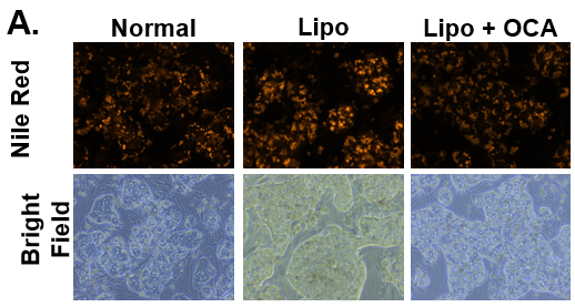 Decrease in lipid synthesis when treated with lipotoxic media (25 mM glucose and 320 µM Oleic acid) plus OCA (0.5 µM). Normal PHHs in hTCS media (normal), treated with high glucose and Oleic acid without (Lipo) and with OCA (Lipo + OCA).
